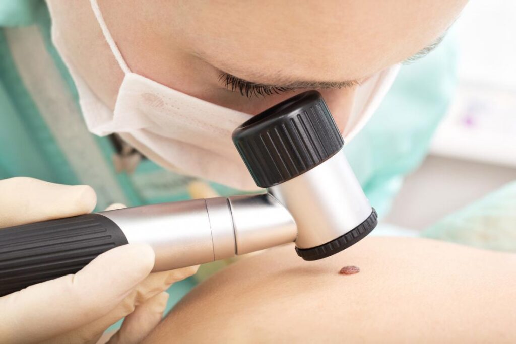 What is Melanoma Treatments