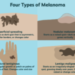 Types of Melanoma